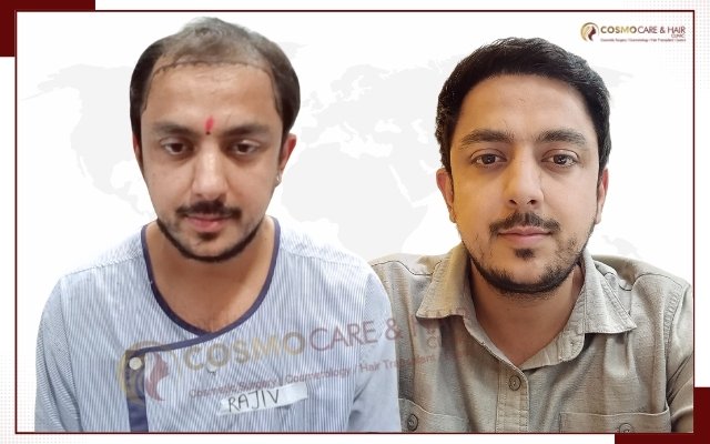 Before hair transplant, receding hairline
